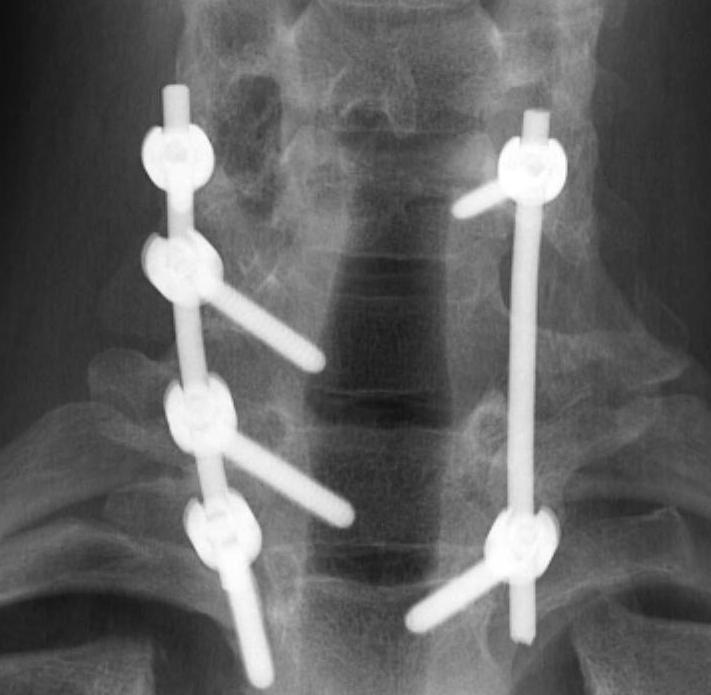 Osteoblastoma Exision and Fusion0002